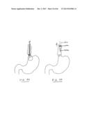 DEVICES AND METHODS FOR GASTROINTESTINAL BYPASS diagram and image