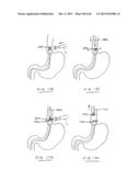 DEVICES AND METHODS FOR GASTROINTESTINAL BYPASS diagram and image