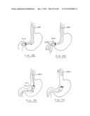 DEVICES AND METHODS FOR GASTROINTESTINAL BYPASS diagram and image