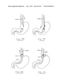 DEVICES AND METHODS FOR GASTROINTESTINAL BYPASS diagram and image