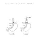 DEVICES AND METHODS FOR GASTROINTESTINAL BYPASS diagram and image