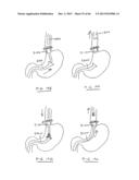 DEVICES AND METHODS FOR GASTROINTESTINAL BYPASS diagram and image