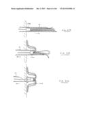 DEVICES AND METHODS FOR GASTROINTESTINAL BYPASS diagram and image