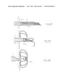 DEVICES AND METHODS FOR GASTROINTESTINAL BYPASS diagram and image