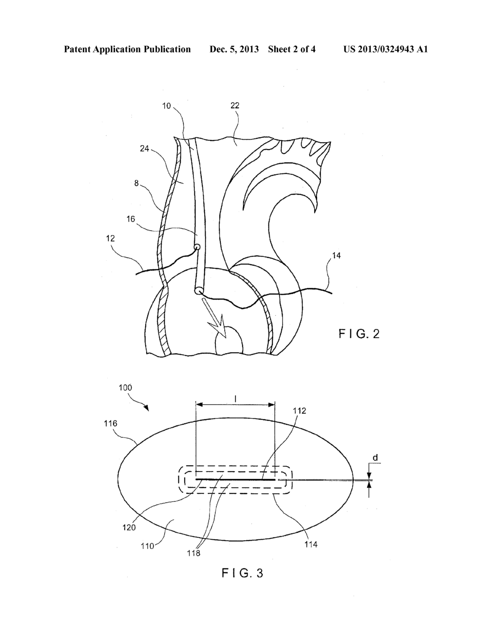 Pressure Actuated Valve with Curved Slit Configuration - diagram, schematic, and image 03