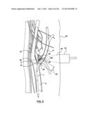 Methods and Devices for Cryogenic Carotid Body Ablation diagram and image