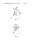 Methods and Devices for Forming Bone Tunnels diagram and image