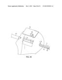 Methods and Devices for Forming Bone Tunnels diagram and image