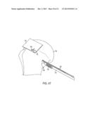 Methods and Devices for Forming Bone Tunnels diagram and image