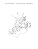 METHOD OF SURGICALLY PREPARING A PATIENT S FEMUR diagram and image