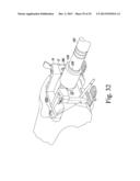 METHOD OF SURGICALLY PREPARING A PATIENT S FEMUR diagram and image