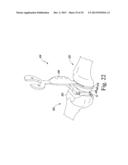 FEMORAL ORTHOPAEDIC SURGICAL INSTRUMENTS AND  METHOD OF USE OF SAME diagram and image