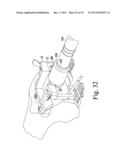 METHOD OF ASSEMBLING AND POSITIONING A FEMORAL ORTHOPAEDIC SURGICAL     INSTRUMENT diagram and image