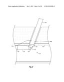 SYSTEMS, METHODS, AND DEVICES FOR CLOSING HOLES IN BODY LUMENS diagram and image