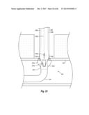 SYSTEMS, METHODS, AND DEVICES FOR CLOSING HOLES IN BODY LUMENS diagram and image