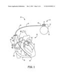 IMPLANTABLE DEVICE LEAD INCLUDING A DISTAL ELECTRODE ASSEMBLY WITH A     COILED COMPONENT diagram and image