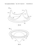 PROSTHETIC HEART VALVE HAVING A POLYMERIC STENT diagram and image