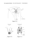 REGISTRATION DEVICE, SYSTEM, KIT AND METHOD FOR A PATIENT REGISTRATION diagram and image