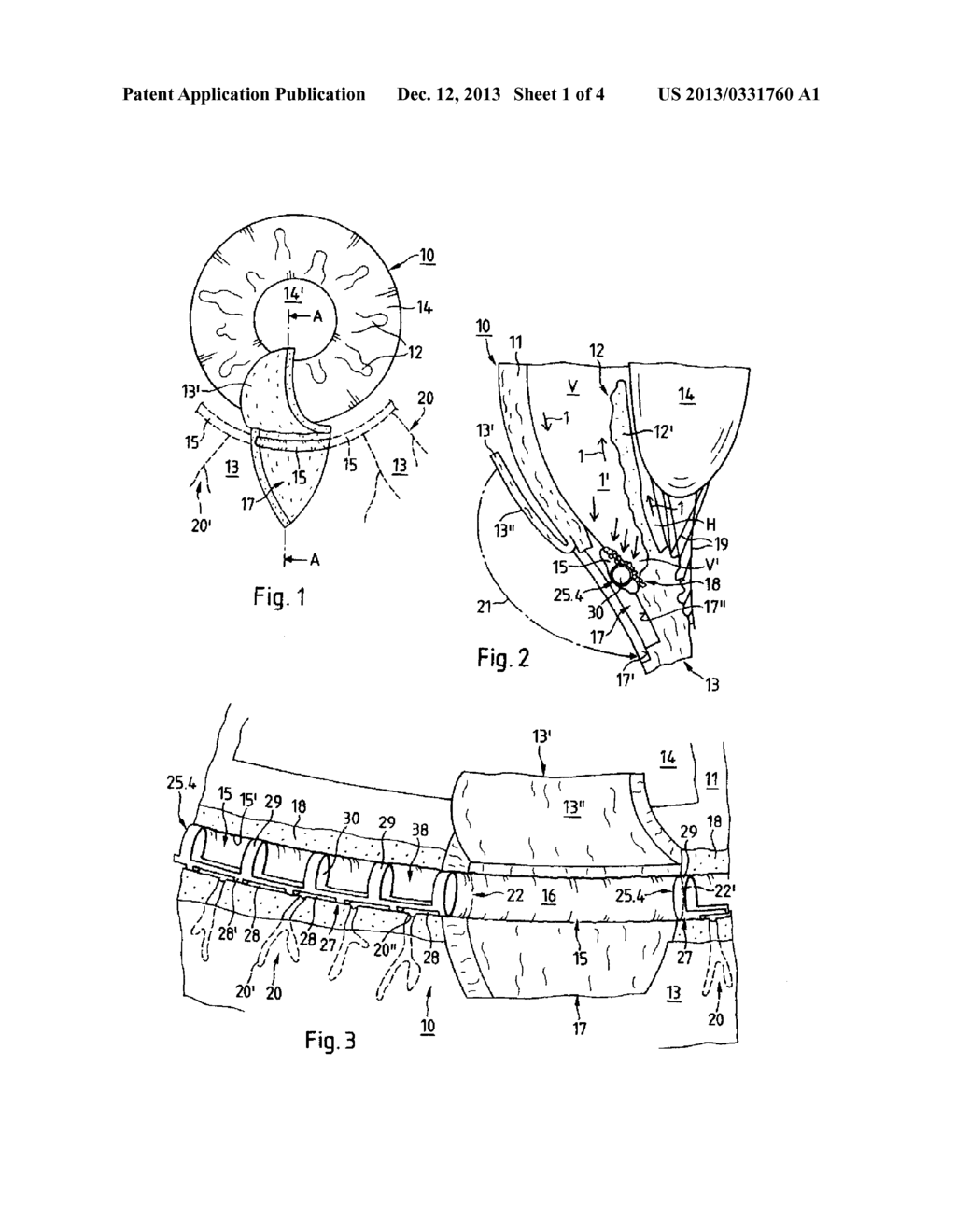 IMPLANT FOR THE TREATMENT OF GLAUCOMA - diagram, schematic, and image 02