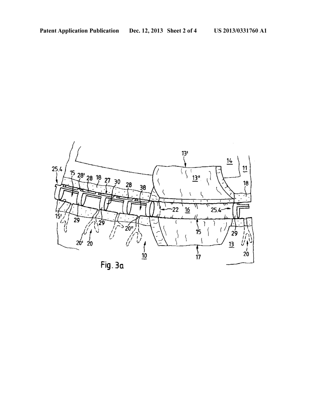 IMPLANT FOR THE TREATMENT OF GLAUCOMA - diagram, schematic, and image 03