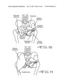 ANGLED REAMER SPINDLE FOR MINIMALLY INVASIVE HIP REPLACEMENT SURGERY diagram and image