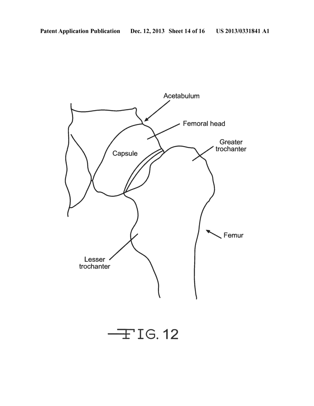 ANGLED REAMER SPINDLE FOR MINIMALLY INVASIVE HIP REPLACEMENT SURGERY - diagram, schematic, and image 15