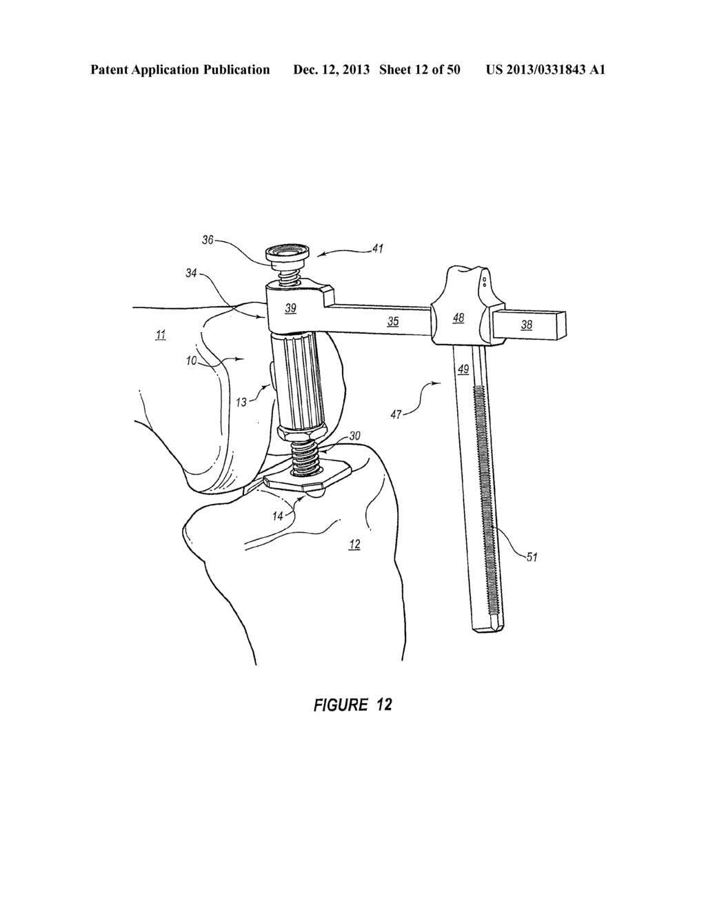 ARTHROPLASTY SYSTEMS AND METHODS FOR OPTIMALLY ALIGNING AND TENSIONING A     KNEE PROSTHESIS - diagram, schematic, and image 13