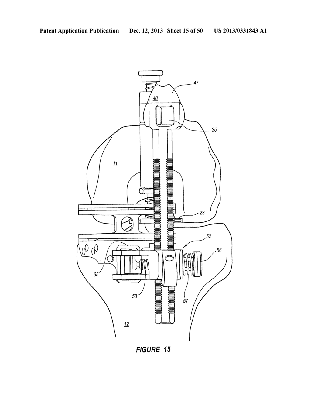 ARTHROPLASTY SYSTEMS AND METHODS FOR OPTIMALLY ALIGNING AND TENSIONING A     KNEE PROSTHESIS - diagram, schematic, and image 16