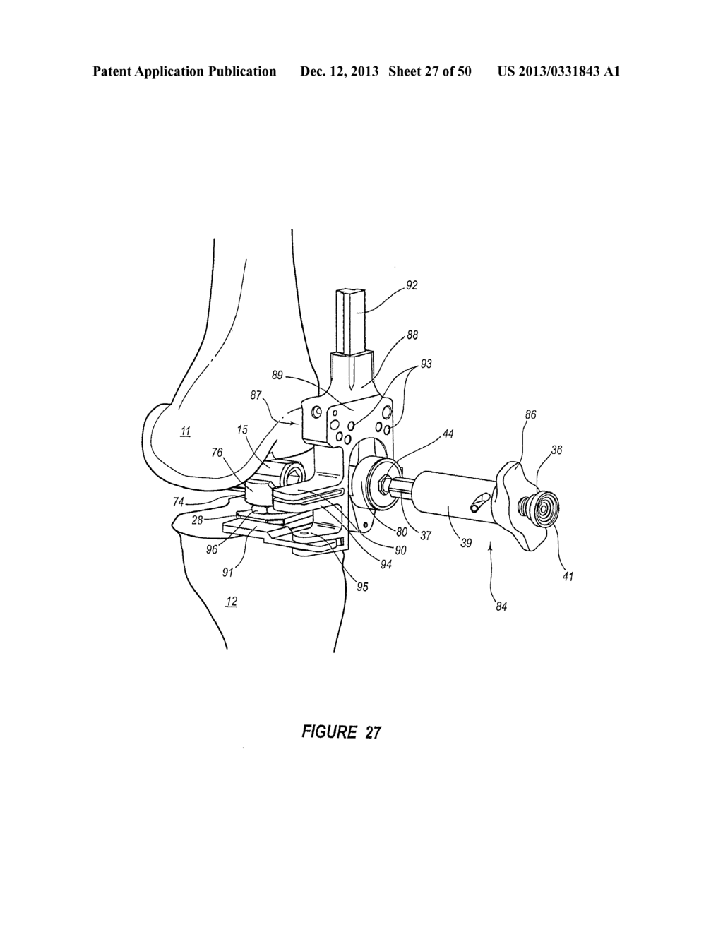 ARTHROPLASTY SYSTEMS AND METHODS FOR OPTIMALLY ALIGNING AND TENSIONING A     KNEE PROSTHESIS - diagram, schematic, and image 28