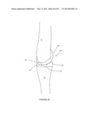 ARTHROPLASTY SYSTEMS AND METHODS FOR OPTIMALLY ALIGNING AND TENSIONING A     KNEE PROSTHESIS diagram and image