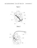 Methods and Apparatus to Stimulate Heart Atria diagram and image