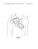 PLANAR TRANSFORMER ASSEMBLIES FOR IMPLANTABLE CARDIOVERTER DEFIBRILLATORS diagram and image