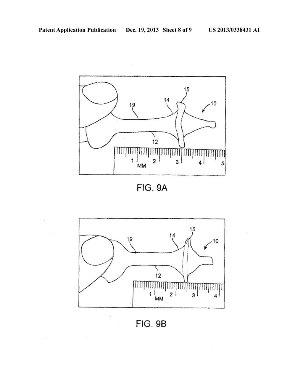 FECAL INCONTINENCE DEVICE, SYSTEM AND METHOD - diagram, schematic, and image 09