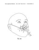 NASAL TUBE DEVICE AND METHOD diagram and image