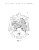 TREATMENT OF SUBARACHNOID HEMATOMA USING SONOTHROMBOLYSIS AND ASSOCIATED     DEVICES, SYSTEMS AND METHODS diagram and image