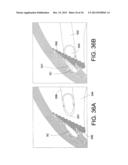 Methods and Apparatus for Delivering Ocular Implants Into the Eye diagram and image