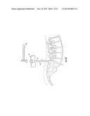 GUIDEWIRE AND METHOD FOR SURGICAL PROCEDURES diagram and image