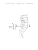 GUIDEWIRE AND METHOD FOR SURGICAL PROCEDURES diagram and image