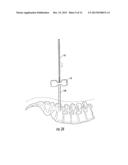 GUIDEWIRE AND METHOD FOR SURGICAL PROCEDURES diagram and image