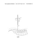 GUIDEWIRE AND METHOD FOR SURGICAL PROCEDURES diagram and image