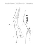 Method and Apparatus for Minimally Invasive Subcutaneous Treatment of Long     Bone Fractures diagram and image