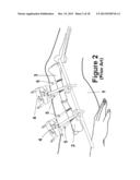 Method and Apparatus for Minimally Invasive Subcutaneous Treatment of Long     Bone Fractures diagram and image