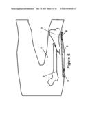 Method and Apparatus for Minimally Invasive Subcutaneous Treatment of Long     Bone Fractures diagram and image