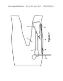 Method and Apparatus for Minimally Invasive Subcutaneous Treatment of Long     Bone Fractures diagram and image