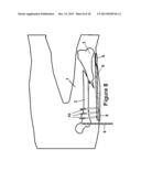 Method and Apparatus for Minimally Invasive Subcutaneous Treatment of Long     Bone Fractures diagram and image