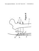 Method and Apparatus for Minimally Invasive Subcutaneous Treatment of Long     Bone Fractures diagram and image