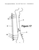 Method and Apparatus for Minimally Invasive Subcutaneous Treatment of Long     Bone Fractures diagram and image