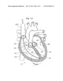 DEVICES AND METHODS FOR REDUCING CARDIAC VALVE REGURGITATION diagram and image