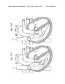 DEVICES AND METHODS FOR REDUCING CARDIAC VALVE REGURGITATION diagram and image