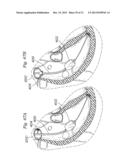 DEVICES AND METHODS FOR REDUCING CARDIAC VALVE REGURGITATION diagram and image